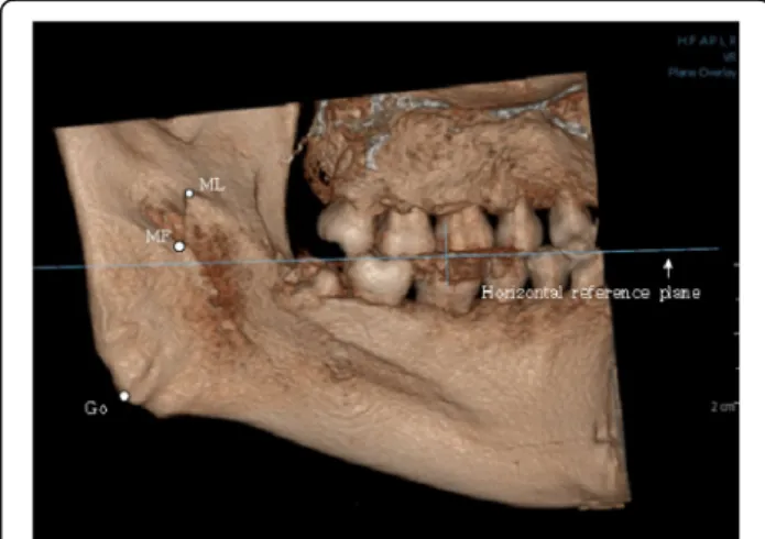 Fig. 1 The occlusal plane was set as the horizontal reference plane to standardize the 3D positions of all the mandible models