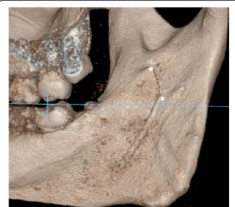Fig. 4 ML above the occlusal plane; MF at the level of occlusal plane. The blue line indicates the occlusal plane