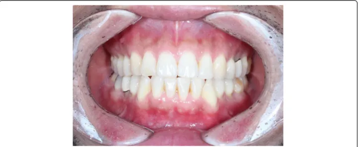 Fig. 6 Dental midline is corrected after the surgery