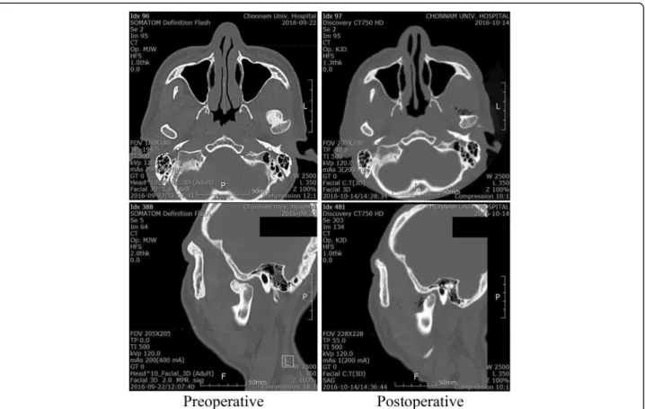 Fig. 7 Preoperative CT scan (left) and postoperative CT scan (right)