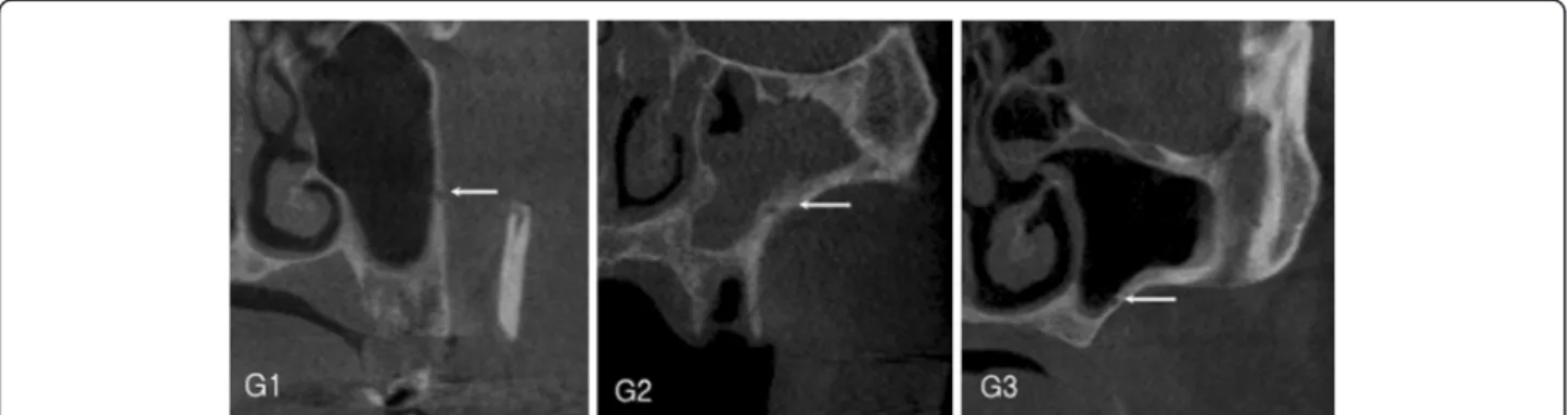 Table 1 The vertical position of the bony canals according to the tooth region (mean ± SD, mm)