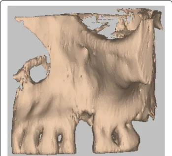 Fig. 2 3D volumetric reconstruction of the bone defect Fig. 3 Hydroxyapatite bone graft, built using CAD/CAM