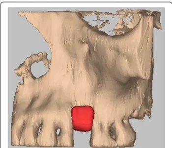 Fig. 4 Hydroxyapatite bone graft CAD/CAM inserted at the level of the bone defect
