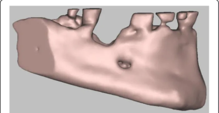 Fig. 5 3D digital volumetric reconstruction of the mandibular defect