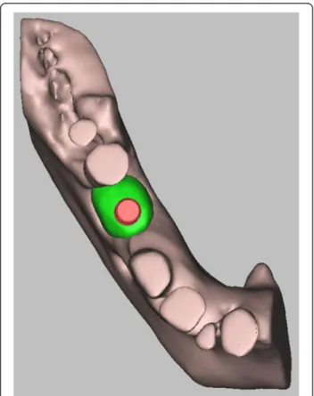Fig. 8 3D digital volumetric reconstruction of implant placement in regenerated bone