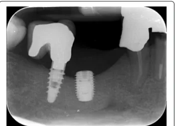 Fig. 15 Clinical view: HA scaffold placement