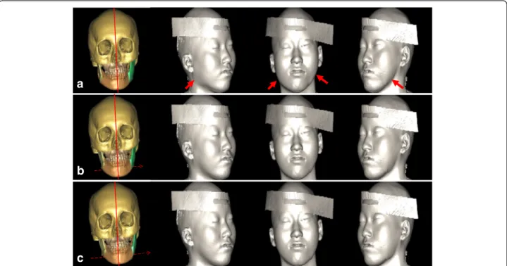 Fig. 2 a Virtual simulation based on cephalometric prediction. Although midline correction was achieved (red line), the contour correction was inadequate (arrows)