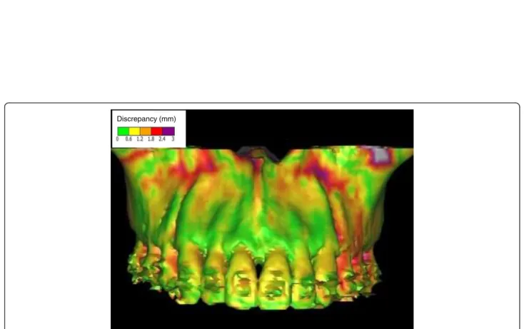 Fig. 6 Visual superimposed volumetric image of hard tissue discrepancy between the virtual planning result and 3-month postoperative result.