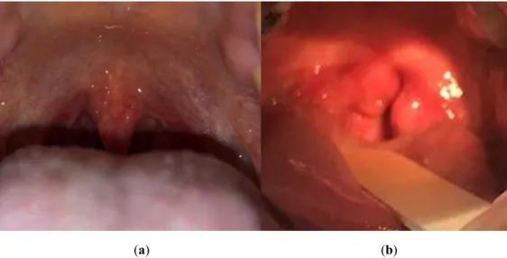 Figure 1.  Example of a healthy and strep throat. (a) Healthy throat where there is no sign of any  infection, and (b) strep throat where there are red swollen uvula and tonsils, and whitish spots on the  throat.