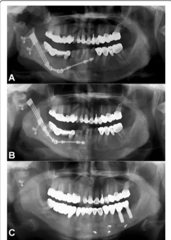 Fig. 3 Comparison of pre- and postdistraction panoramic views.