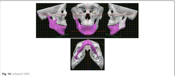 Fig. 16 Unilateral SSRO