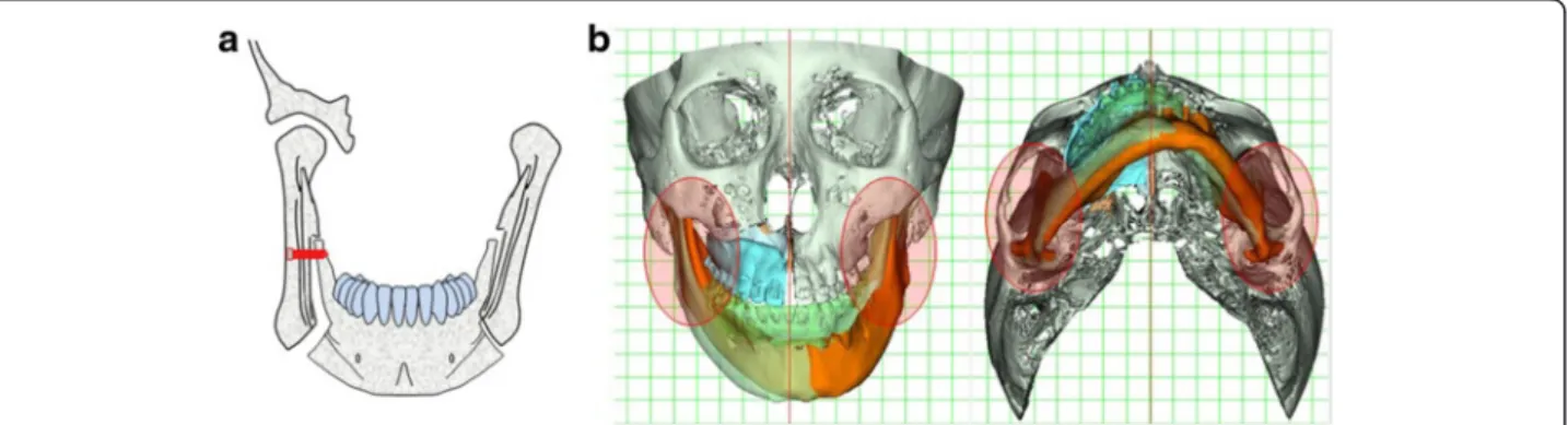 Fig. 19 Ramus positioning. a Flaring out of the condylar proximal segment. b Superimposition of the simulated model on the original one