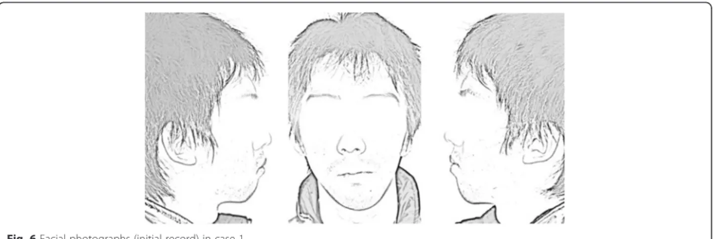 Figure 9 demonstrates the skeletal problems in the cra- cra-nial coordinates, which are the mandibular lateral  dis-placement toward the left accompanied with rotation both in the frontal (Fig