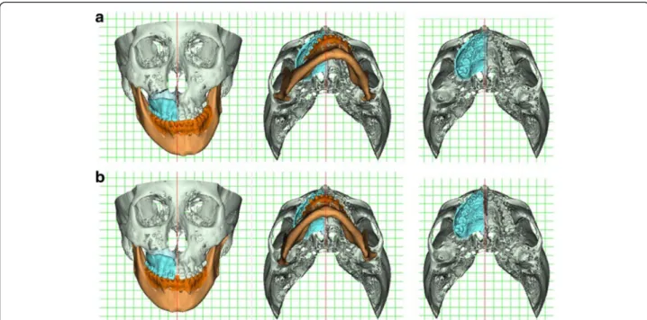 Fig. 12 3D simulation in case 1. a Original model. b Simulated model. Mandible: SSRO. Maxilla: unilateral RME assisted by Le Fort I corticotomy