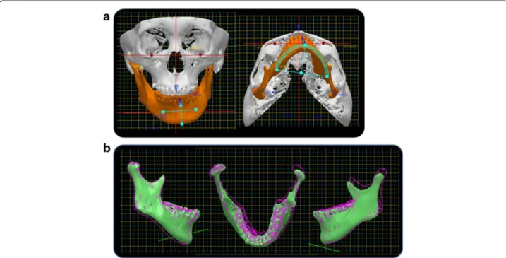 Fig. 15 3D diagnosis and simulation in case 2. a Original model. b Superimposition of the simulated model on the original one (solid line)
