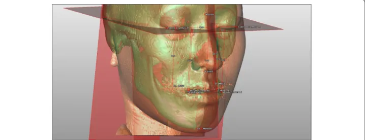 Fig. 1 Reference planes, points, and measurements in three-dimensional CT images