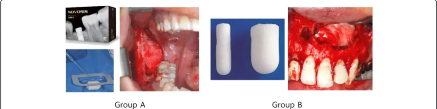 Fig. 1 Surgical procedures for group A and group B. In group A, ACS with absorbed rhBMP-2 was applied to the bone defects