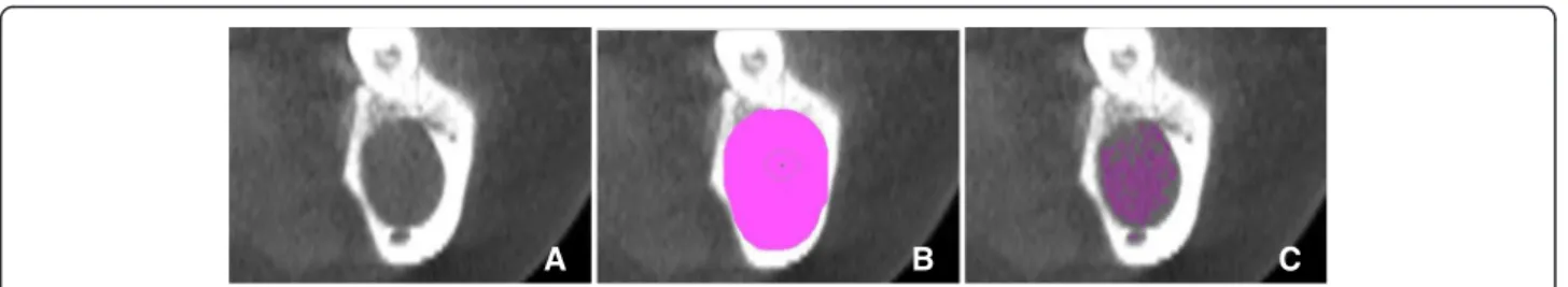 Fig. 2 Selection of pixels within the range of Hounsfield units desired (selection process)