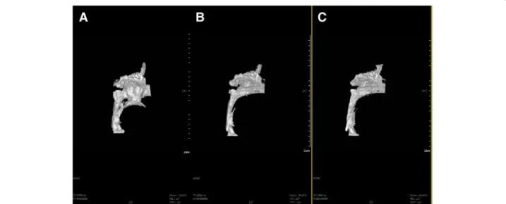 Fig. 2 Volumetric analysis of the three-dimensional reconstruction of the airway. a Preoperatively