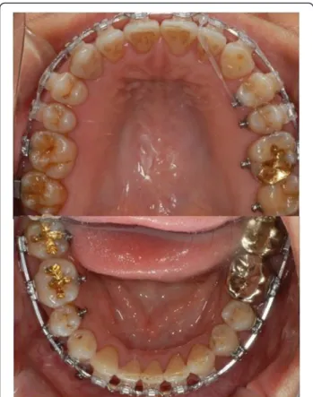 Fig. 10 Postoperative intra-oral photo of case 2 showing corrected inter molar width of maxilla (maxillary inter molar width 41 mm, mandibular inter molar width 40 mm)