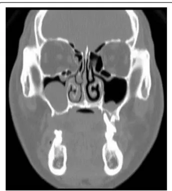 Fig. 2 Preoperative PNS CT view. Dome-shaped radiopacity is observed in the right maxillary sinus
