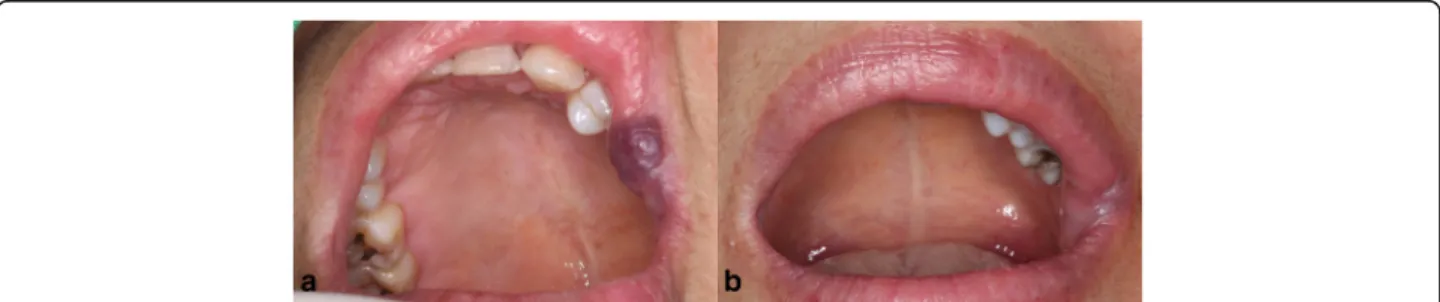 Fig. 3 a Well-defined border and dome-shaped swelling on the left upper lip. The patient was diagnosed with venous malformation.