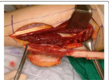 Fig. 7 Bone defect about 50 mm. Reconstruction plate application