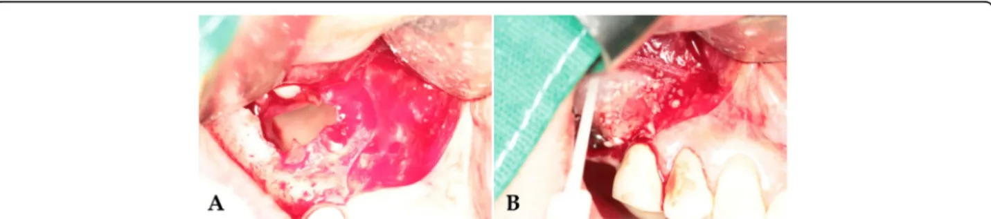 Fig. 1 Schematic drawing of sinus perforation repair using an absorbable membrane. a Procedure of making the lateral window