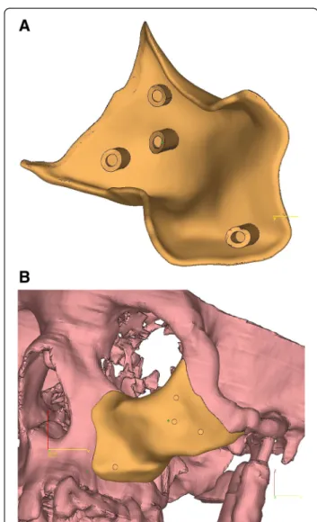 Figure 3 CT scan confirming the left zygomatic deficiency: (A)