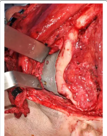 Figure 5 Intraoperative placement and fixation of the implant using 2.0-mm titanium lag-screws(arrows).