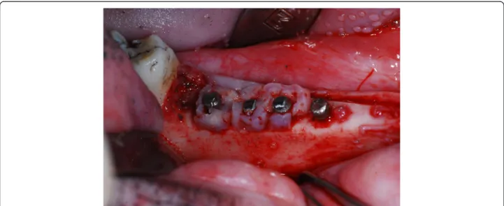 Figure 1 Pineapple-shaped root on type autogenous tooth bones were applied to the vertical defects around the neck area of the posterior three fixtures and the foremost one was not applied with autogenous bone as a control group.