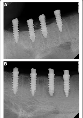 Figure 2 Distal three implants were treated with autogenous tooth bone and showed more radio-opacity around implant than foremost implant after 12 weeks