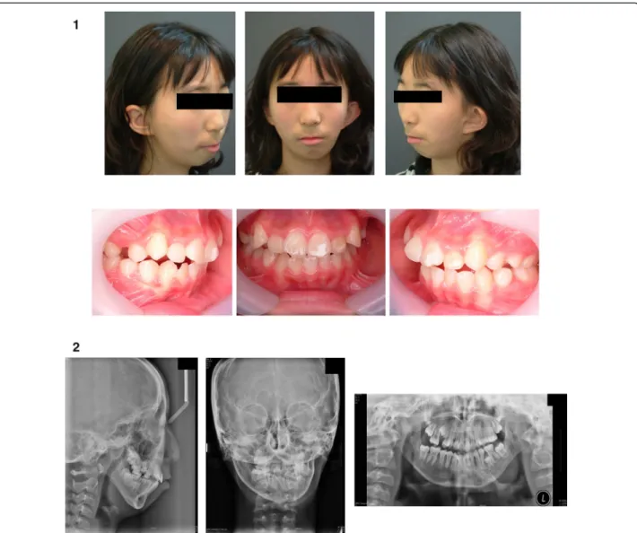 Figure 1 Pre-operative view of patient. 1. Pre-operative extraoral and intraoral photographs