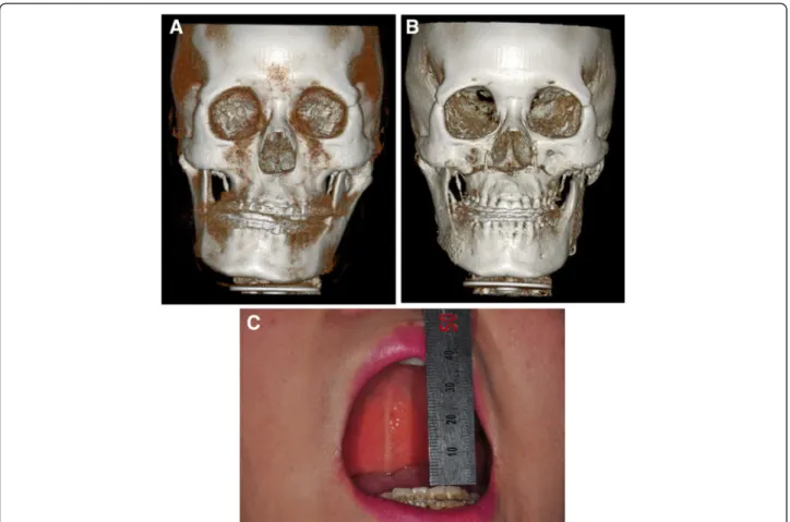 Figure 5 Comparison of the pre-operation and post-operation status. (A) A pre-operation 3D reconstruction