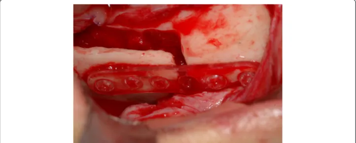 Figure 4 A 2.4 mm 6-hole poly-L/D-lactide plate is applied for fixation of mandibular SSRO.