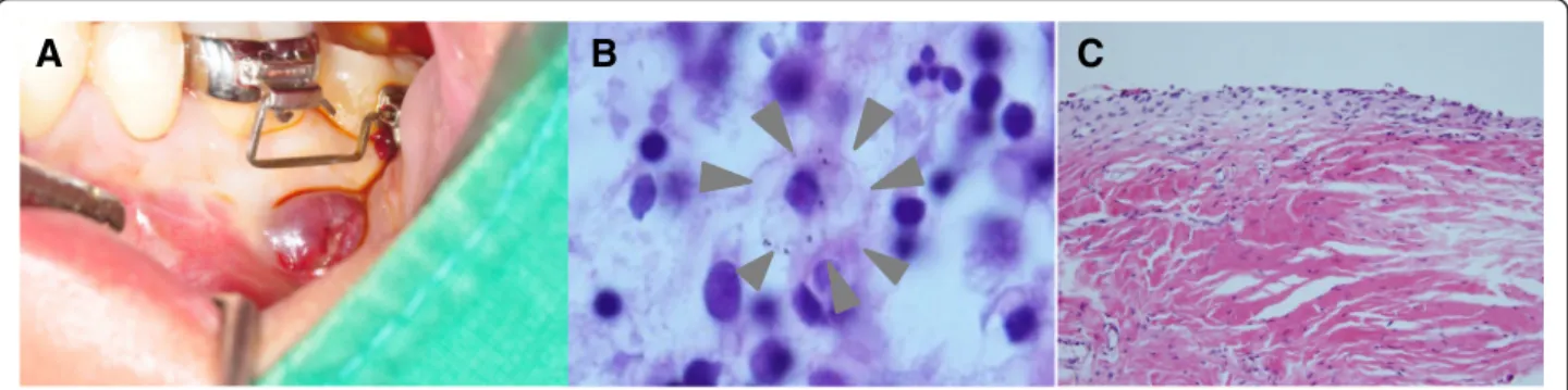 Figure 6 3-dimensional reconstructed CT image showing that two mini-sized, bioabsorbable plates are fractured 7 weeks after implatation.