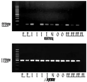Fig. 2. EGFR amplification detected by reverse transcriptase polymerase chain reaction in a control brain (lane 1),  glioblas-tomas (lanes 2-12), and negative control (lane 13)