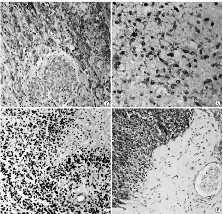 Fig. 3. EGFR immunohistochemistry revealed strong positivity on cell membrane of primary glioblastomas (A; high grade area, B; low grade area) and no immunoreactivity in high grade area (C) in a single case