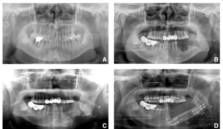 Figure 1 Panoramic view of the osteoradionecrosis progression. (A) Preoperative panoramic view of patient who extracted left 3 rd molar 5 years before the operation