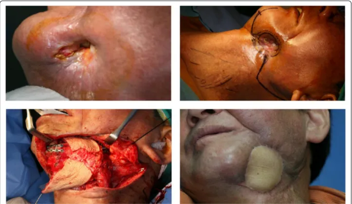 Figure 2 Aggressive osteoradionecrosis formed extraoral fistula and saliva drained by fistula