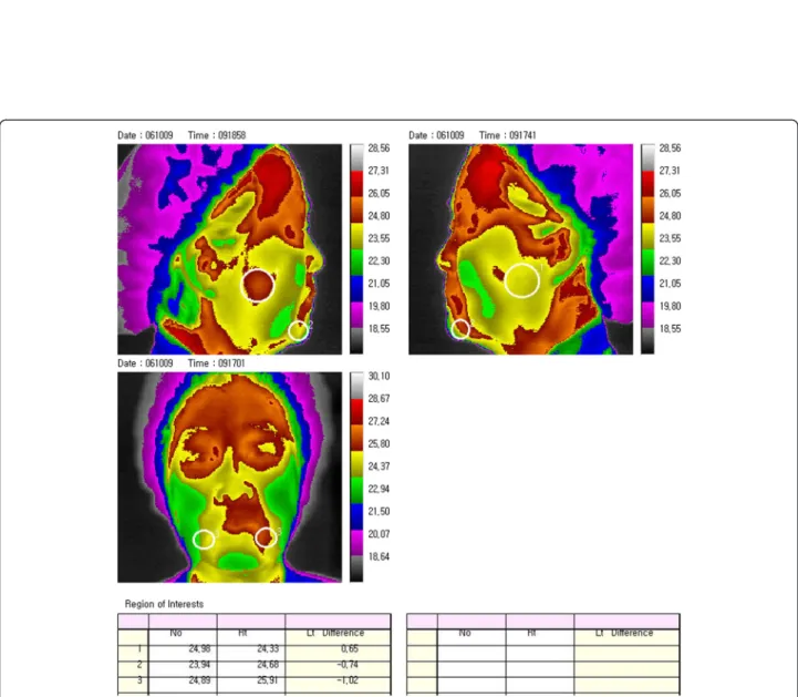Figure 4 Thermography showed that the temperature differences at the region of interest No