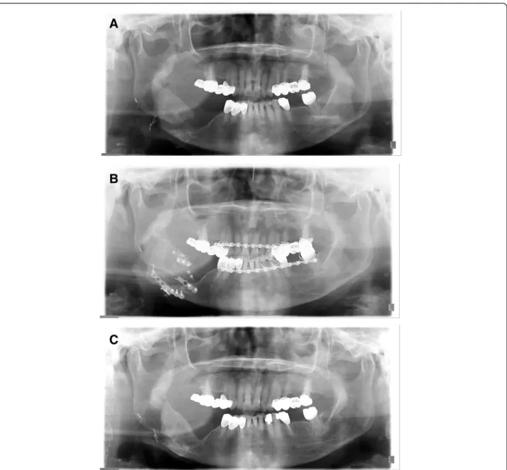 Fig. 1 Panorama series of patient 1. a Pathologic fracture occurred 3 years after radiation therapy