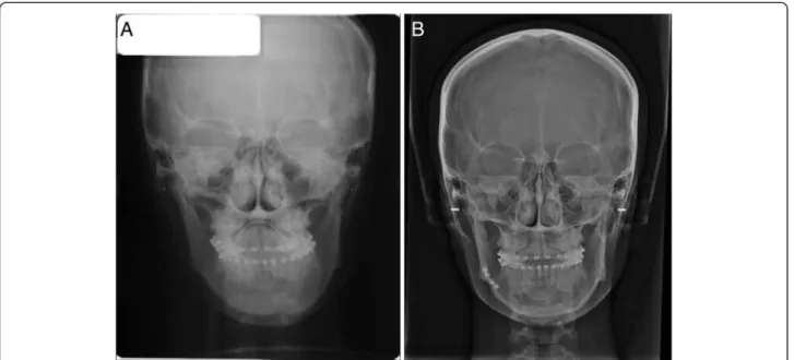 Fig. 5 Radiographic findings of case 1: a pre-operation and b post-operation