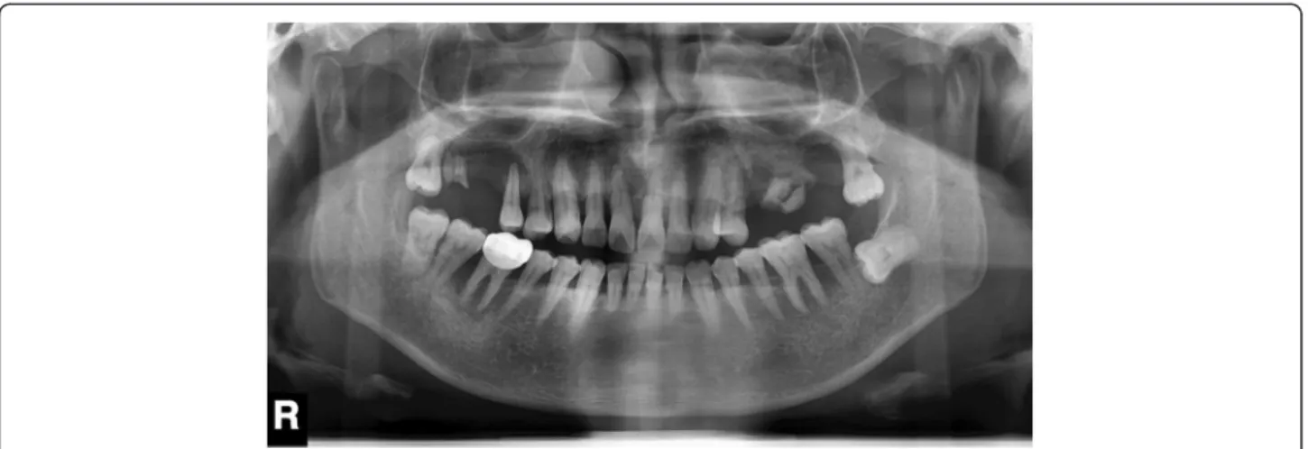 Fig. 1 Panoramic radiographs of bone resorption patterns of left condyle