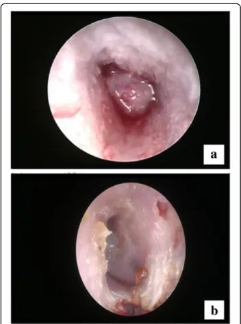 Fig. 5 T2-weighted imaging showing effusion in left mastoid air cell