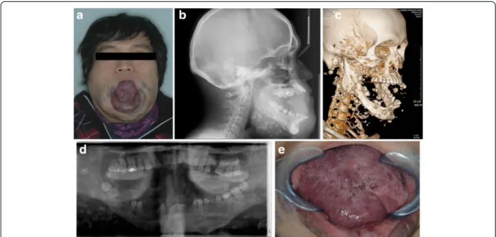 Fig. 1 Preoperative patient information. a The tongue is interpositioned between the teeth, interfering with chewing