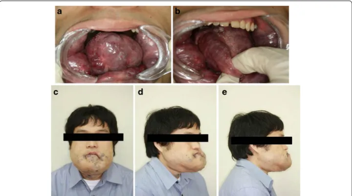 Fig. 3 Postoperative patient information. a, b Complaints of difficulty in breathing, swallowing, and lip incompetence are improved with reduced tongue volume