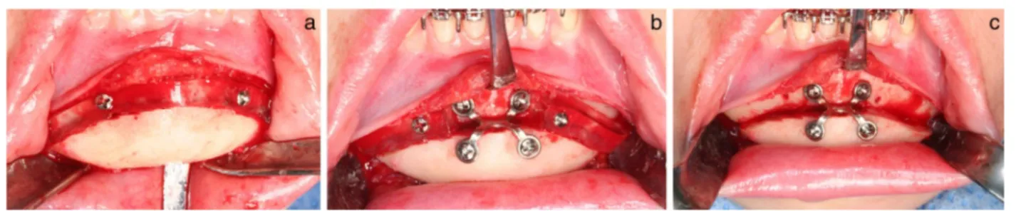 Fig. 3 Advancement genioplasty using a surgical guide. a Intraoperative view with the surgical guide in position, with two screws for fixation, avoiding the eventual position of the metal plate