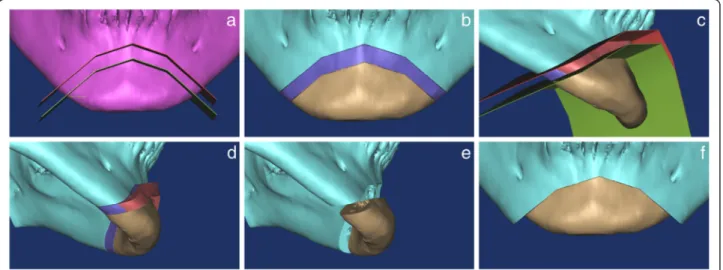 Fig. 4 Surgical simulation and the manufacture of a surgical device for reduction genioplasty