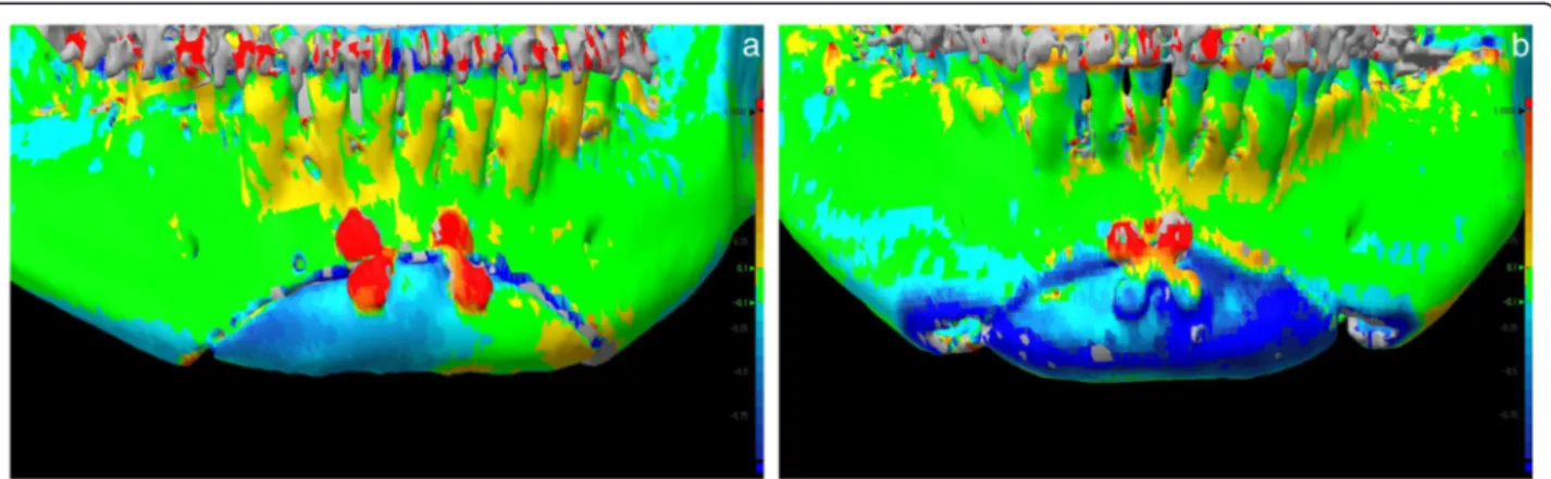 Fig. 6 A high level of accuracy achieved between simulated 3D mandible models and postoperative CT images